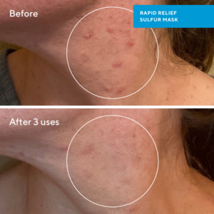 Murad Blemish Control Rapid Relief Sulfur Mask, 74ml.